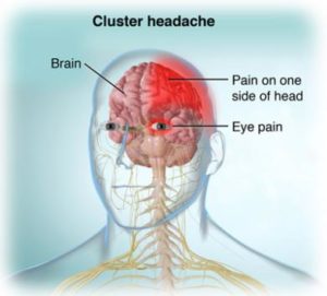الصداع العنقودي - Cluster headache